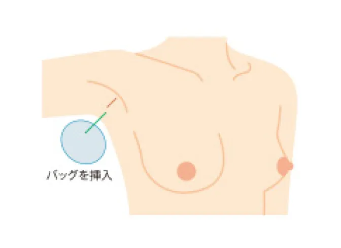 切らない二重術（埋没法）