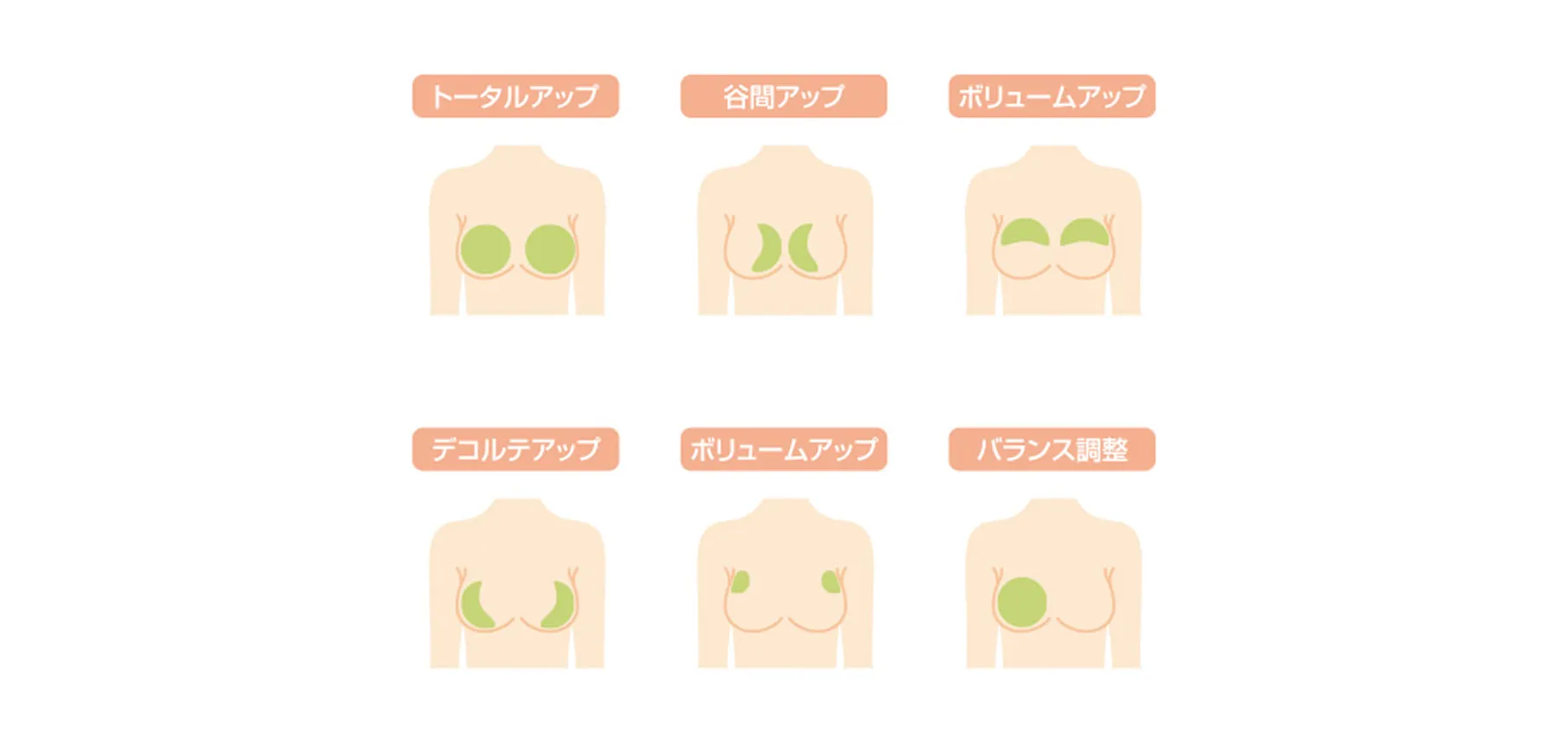 切らない二重術（埋没法）