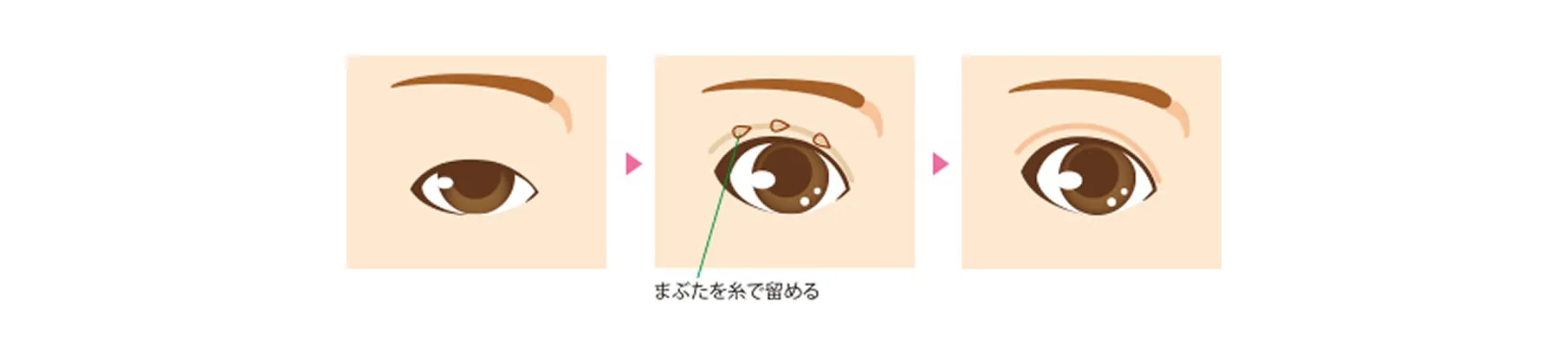 切らない二重術（埋没法）