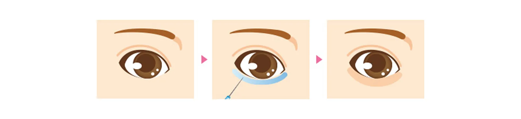 切らない二重術（埋没法）