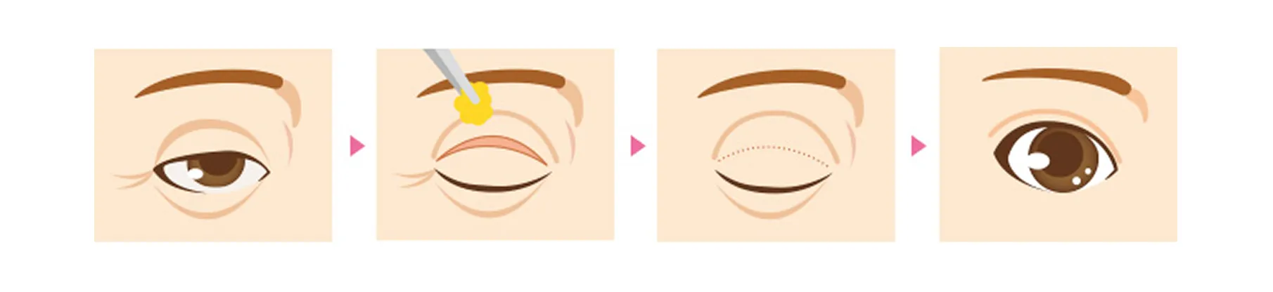 上まぶたのたるみ取り