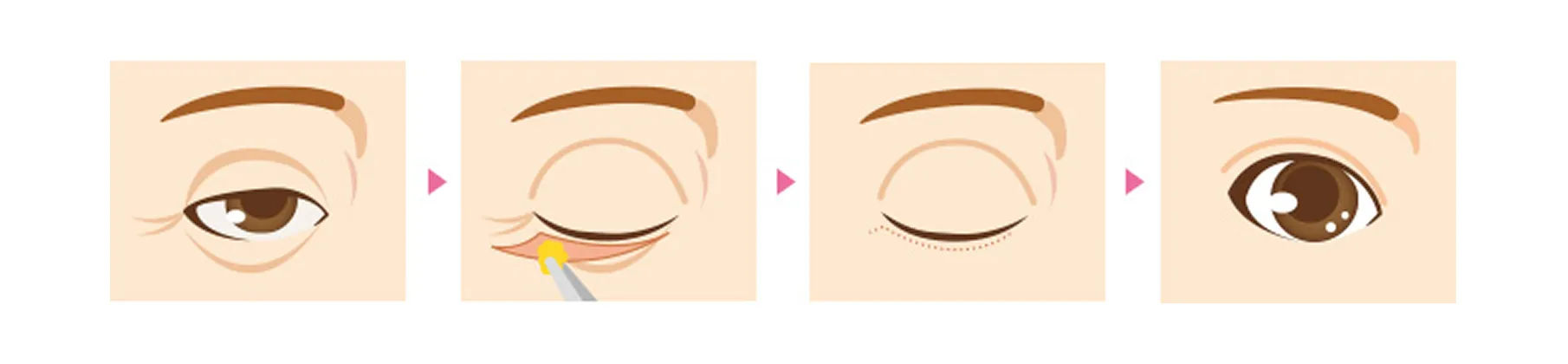 下まぶたのたるみ取り