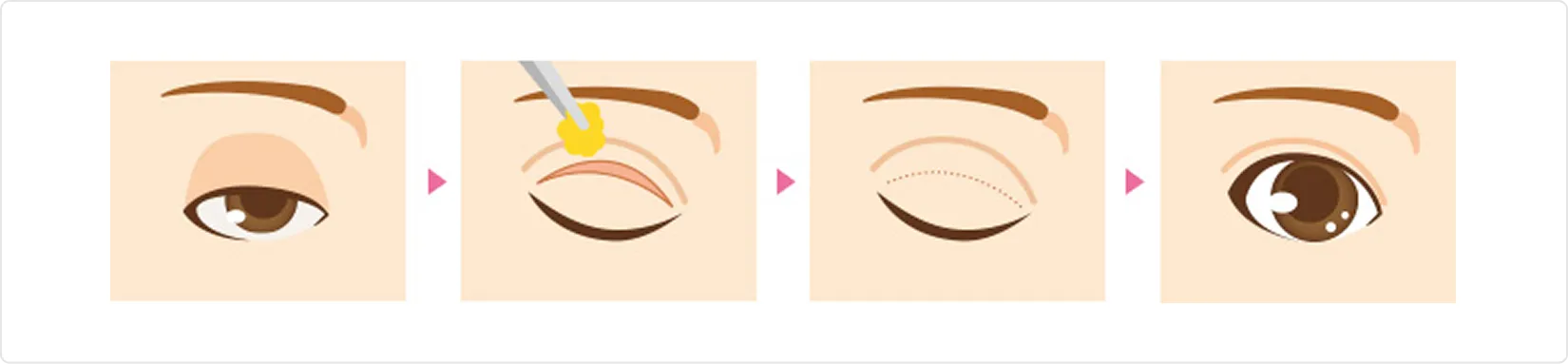 上まぶたの脂肪取り