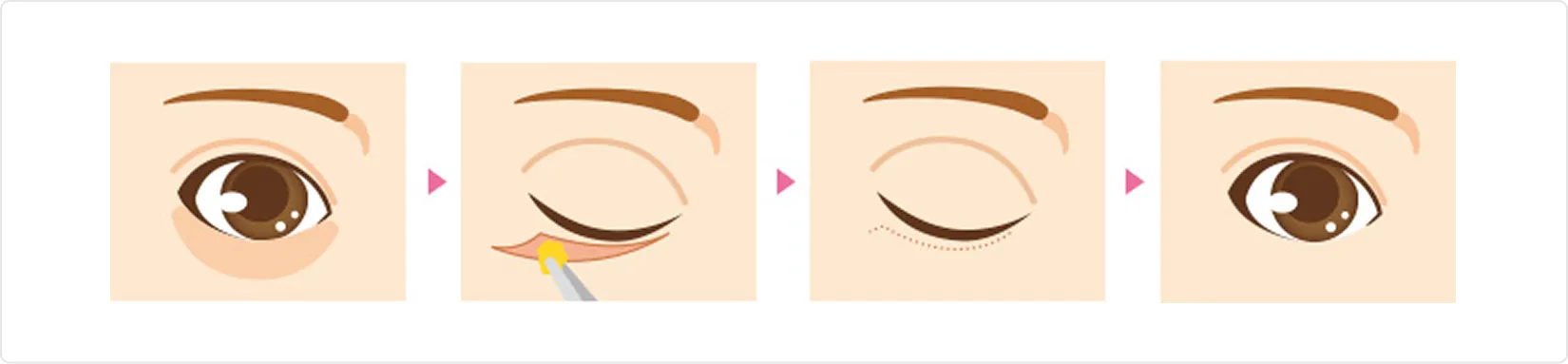 下まぶたの脂肪取り