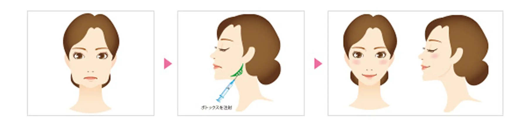 ボトックス注射法