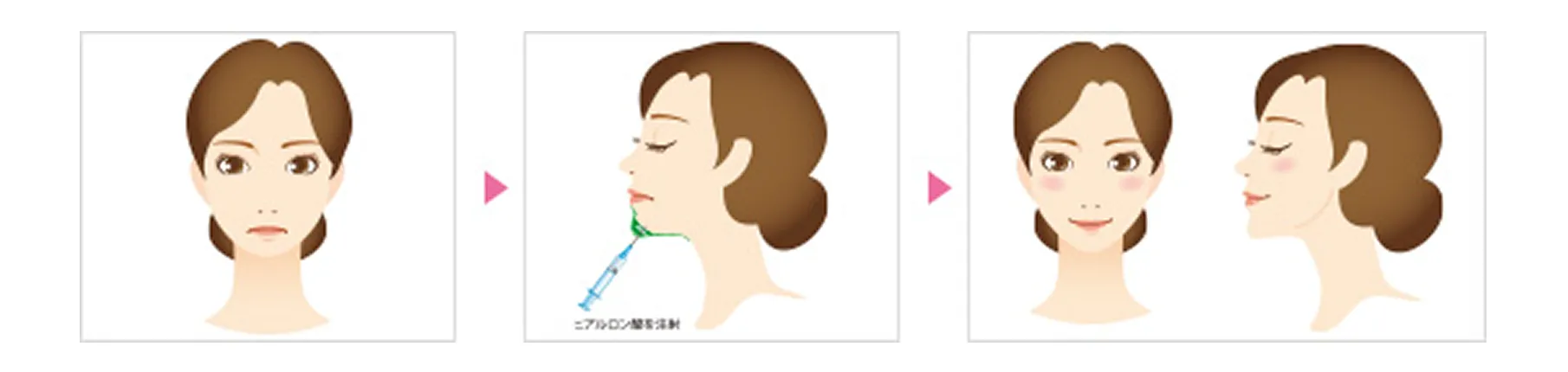 ヒアルロン酸注射法