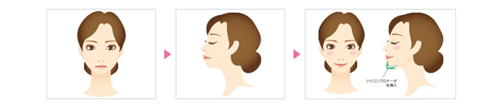 あご形成（シリコンプロテーゼ）