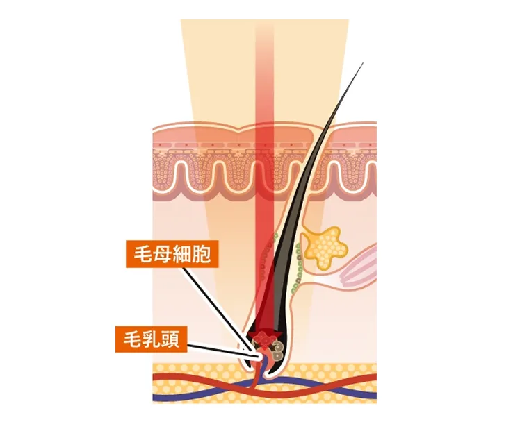 熱破壊式レーザー