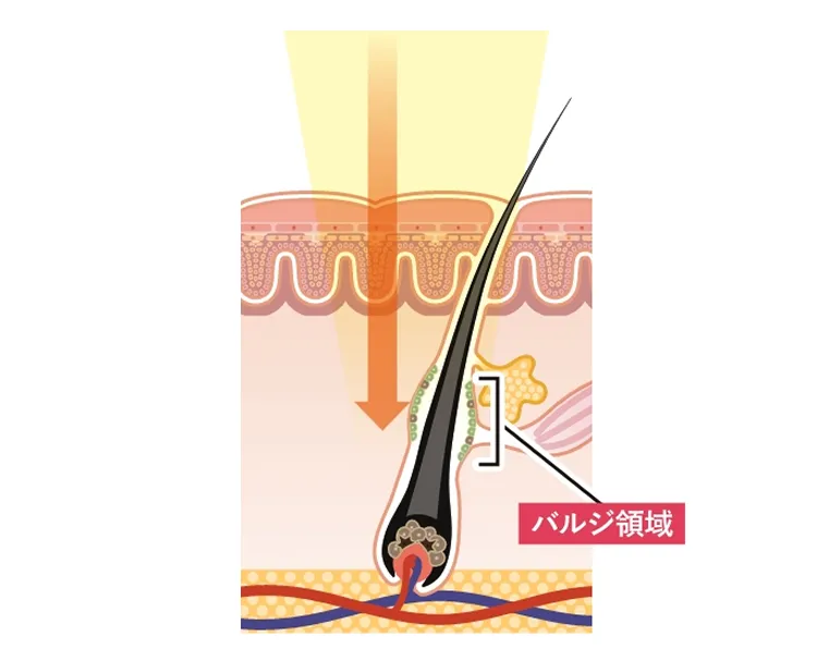 蓄熱式レーザー