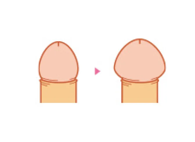亀頭増大