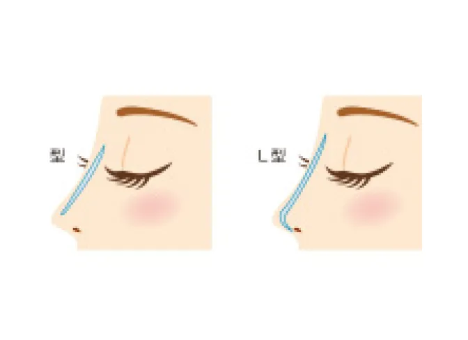 隆鼻術(シリコンプロテーゼ法)