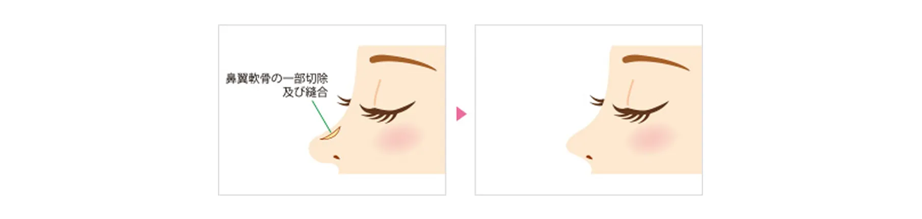 鼻尖形成（だんご鼻解消術）
