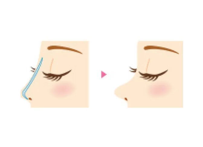 プロテーゼ抜去