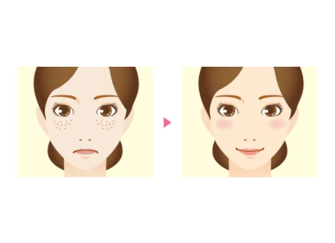 ケミカルピーリング