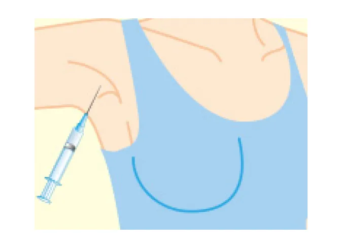 デオドラント注射(ボトックス注射)